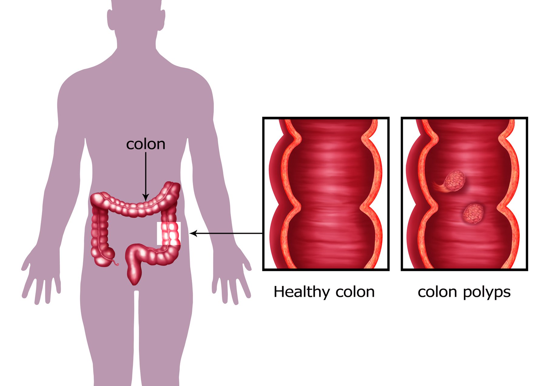 What Causes Colon Polyps Colorectal Cancer Specialists At Compass 